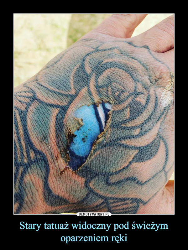 Stary tatuaż widoczny pod świeżym oparzeniem ręki –  