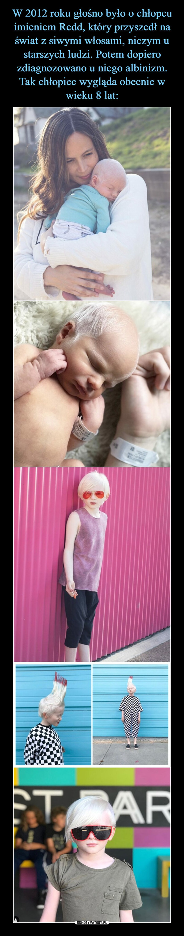 W 2012 roku głośno było o chłopcu imieniem Redd, który przyszedł na świat z siwymi włosami, niczym u starszych ludzi. Potem dopiero zdiagnozowano u niego albinizm. Tak chłopiec wygląda obecnie w wieku 8 lat: