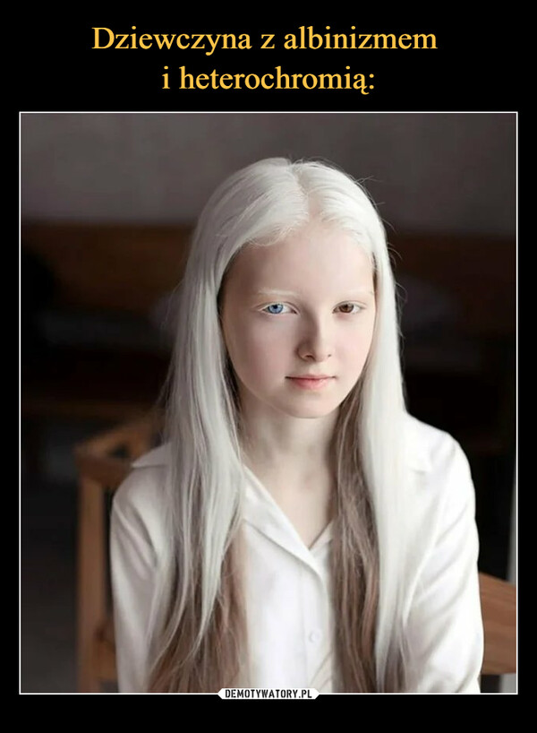 Dziewczyna z albinizmem 
i heterochromią: