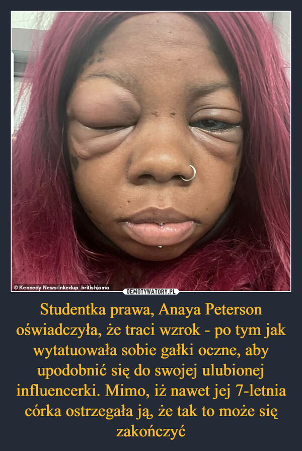 Studentka prawa, Anaya Peterson oświadczyła, że traci wzrok - po tym jak wytatuowała sobie gałki oczne, aby upodobnić się do swojej ulubionej influencerki. Mimo, iż nawet jej 7-letnia córka ostrzegała ją, że tak to może się zakończyć